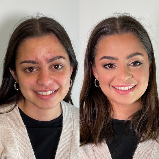 Before and after medium skintone, full coverage makeup covering acne